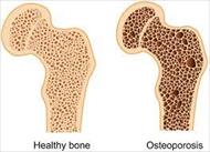 پاورپوینت Osteoporosis پوکی استخوان